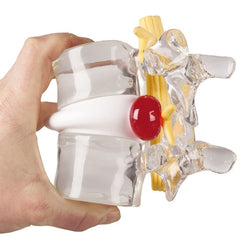 Herniated Disc Model