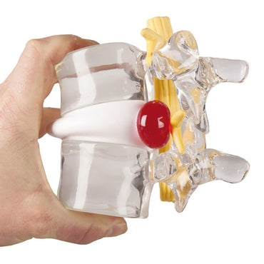 Herniated Disc Model