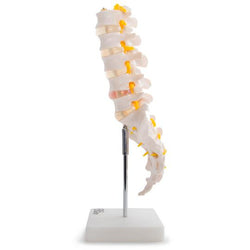 Vertebrae with herniated disc