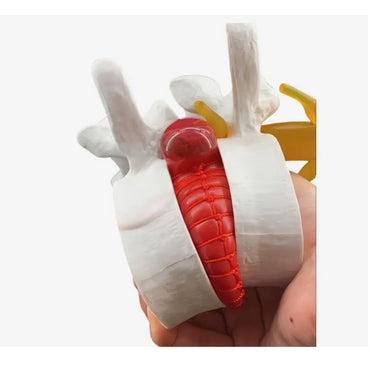 Herniated Disc Model