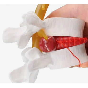 Herniated Disc Simulator