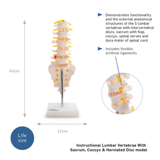 Lumbar vertebrae with herniated disc